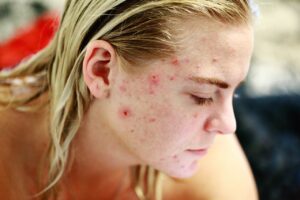 Häufige Arten von Gesichtsausschlägen - Akne